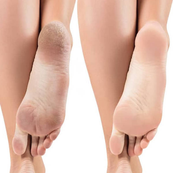 Profesjonalne kapturki ścierne Profico do pedicure