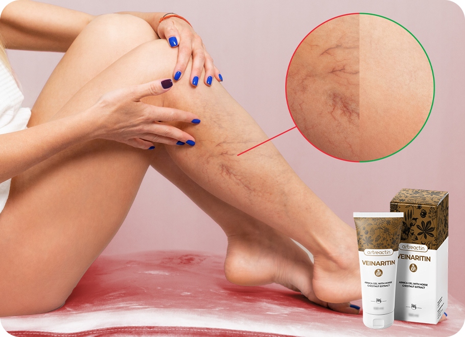 Veinaritin - wsparcie ociężałych nóg, usuwanie żylaków i pajączków