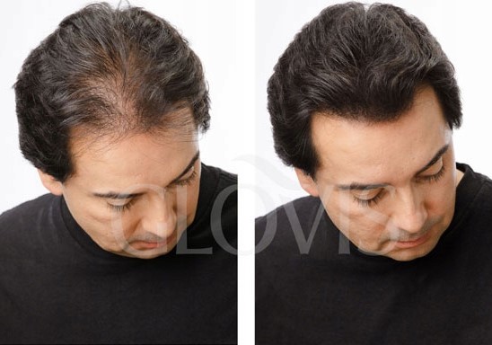 Włókna GLOVIS 28g Ciemny Brąz Dark Brown Mikrowłókna do Włosów Zagęszczenie