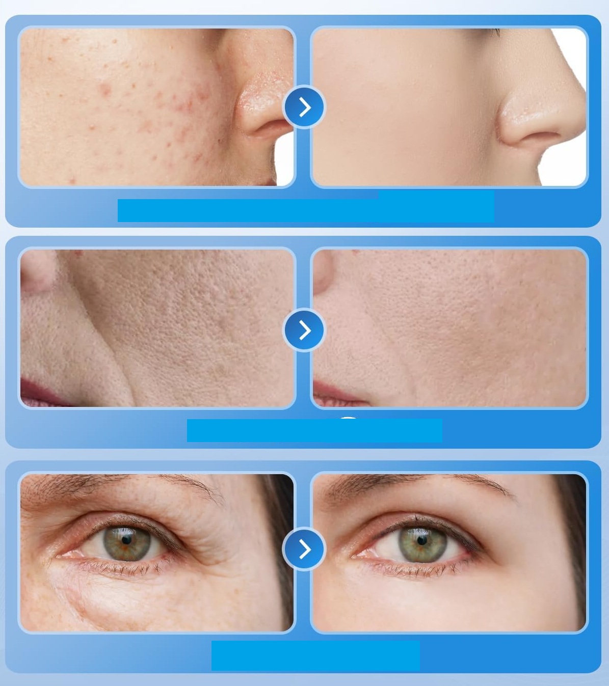 Maska do twarzy LED do terapii światłem KIMTAR na trądzik i zmarszczki