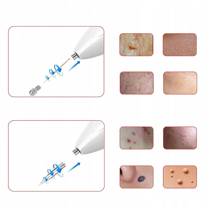 DŁUGOPIS PLAZMOWY PLAZMA PEN LASER IPL LIFTING TWARZY USUWANIE KURZAJEK