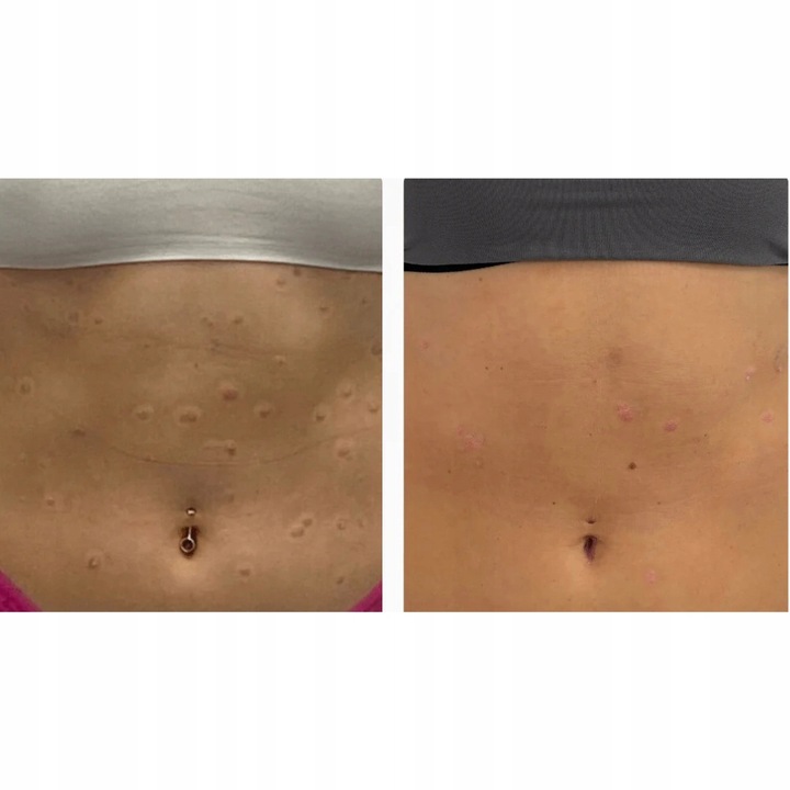 ISOSKIN Spray Podchloranowy 100 ml - Oczyszcza skórę, Łagodzi