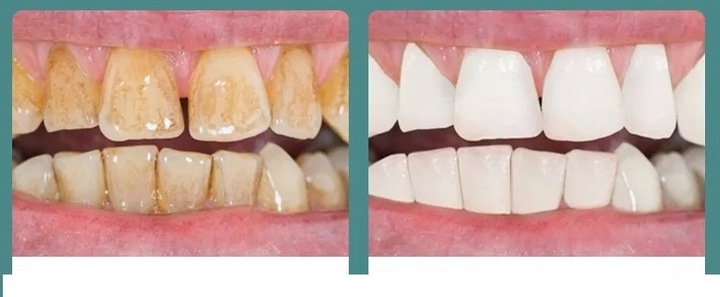 SKALER ULTRADŹWIĘKOWY DO ZĘBÓW DENTYSTYCZNY SMART USUWANIE KAMIENIA