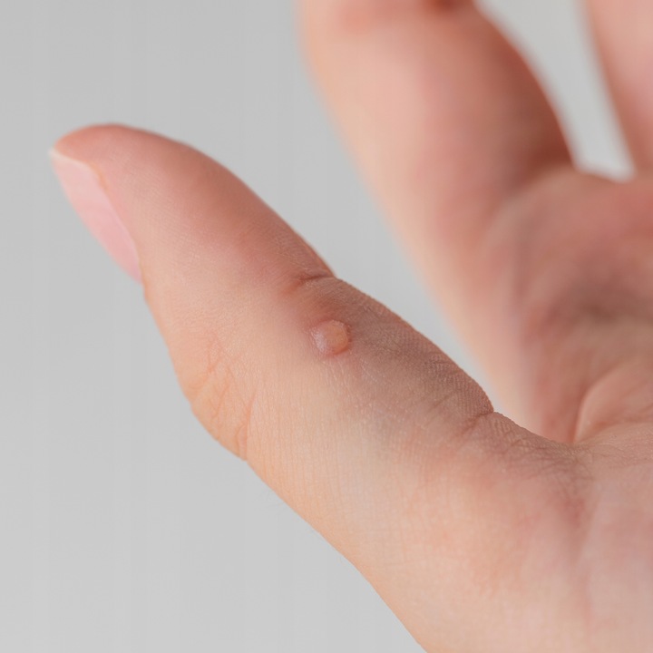 Glistnik Górski na Kurzajki Brodawki Modzele Jaskółcze Ziele Ekstrakt 20 ml