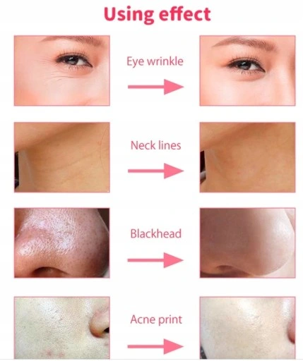 DIAMENTOWA MIKRODERMABRAZJA LIFTING Mocna 100W