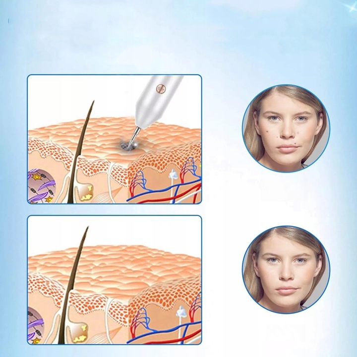 PIÓRO DO LASER USUWANIA ZNAMION PLAZMOWE DO USUWANIA BRODAWEK PIEPRZYK