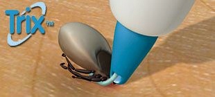 TRIX lasso przyrząd do usuwania kleszczy KLESZCZE