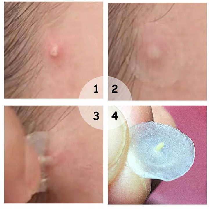 COSRX Acne Pimple Master Patch Plasterki na wypryski -72sztuk