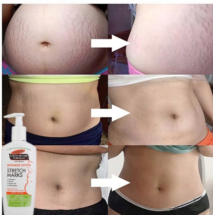 Dobry krem na rozstępy dla nastolatków na plecach brzuchu udach ramionach