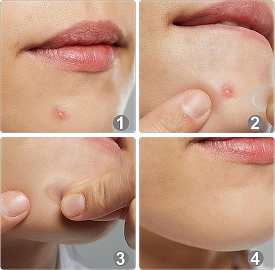 Plaster na Pryszcze trądzik do pryszczy Pimple Patches na Wypryski