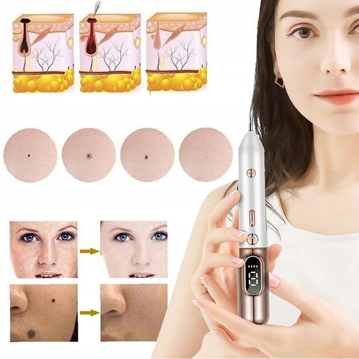 PIÓRO DO LASER USUWANIA ZNAMION PLAZMOWE DO USUWANIA BRODAWEK PIEPRZYK