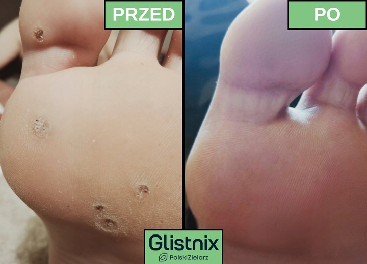 Glistnik Jaskółcze Ziele Kurzajki Brodawki Modzele MOCNY 10 ml