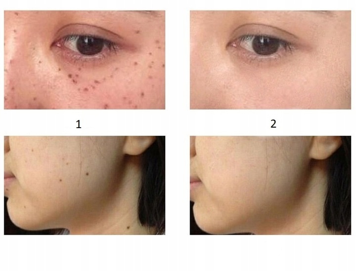 ZESTAW DO USUWANIA BRODAWEK ZMIAN SKÓRNYCH TATUAŻY BLIZN PLAZMA PEN LASER