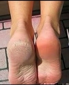 PĘKAJĄCE PIĘTY Gehwol OKLUZJA Regeneracja