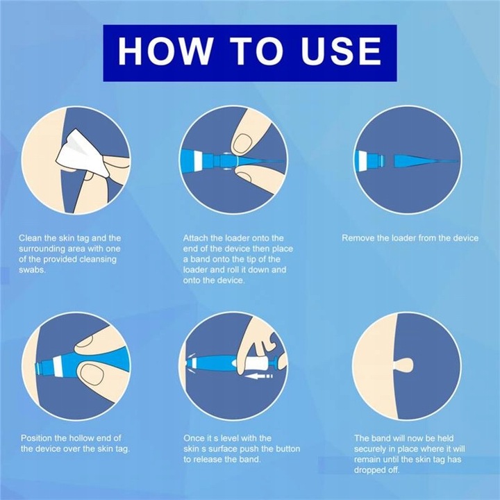 2 In1 Bezbolesne Auto Skóry Tag Mole Zestaw Do Usuwania Brodawek