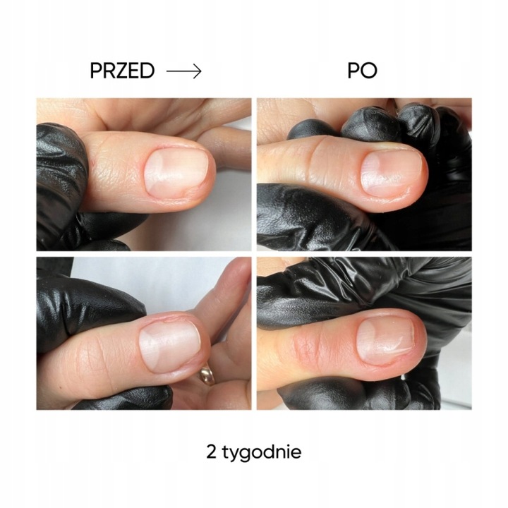 Onycholiza stop! Olejek do paznokci przeciw onycholizie NOTD Onistop 8 ml