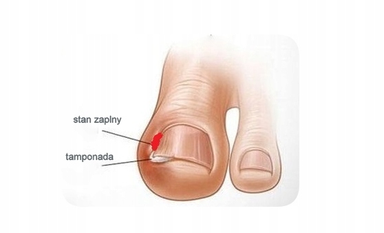 WRASTAJĄCE PAZNOKCIE Sonda Tamponada opatrunek