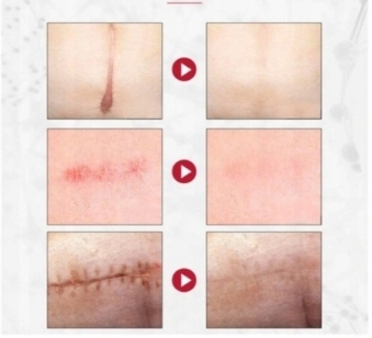 Dermatix żel na blizny 15 g