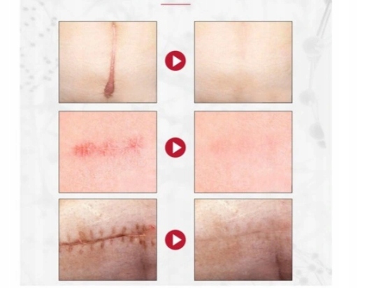 Dermatix Ultra Silikonowy Żel Do Leczenia i Zapobiegania Blizn 15g