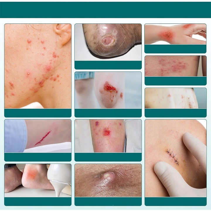 Plastry hydrokoloidowe ochronne szybkie gojenie odcisków pęcherzy