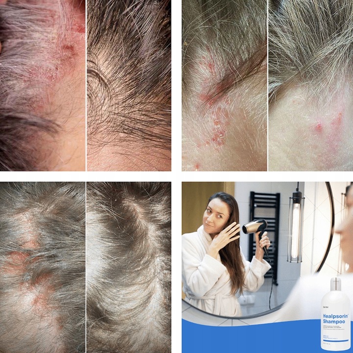 Łuszczyca AZS ŁZS Egzema Szampon Dermz Healpsorin
