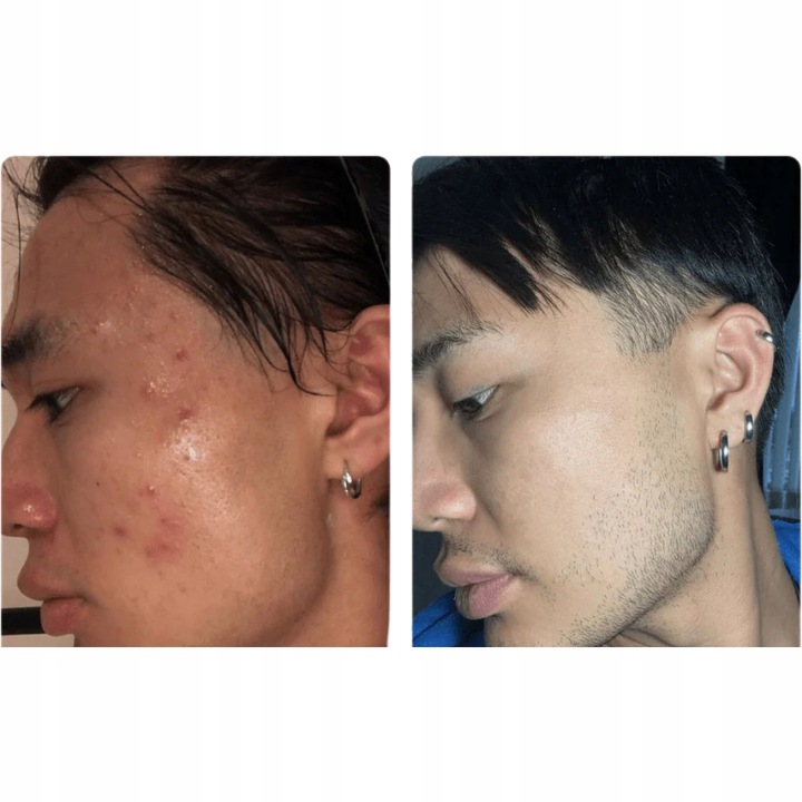 ISOSKIN Spray Podchloranowy 100 ml - Oczyszcza skórę, Łagodzi