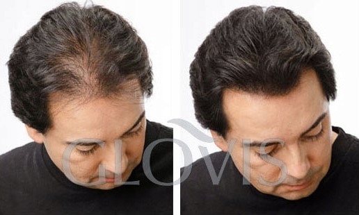 GLOVIS Concealer - Zagęszczanie Włosów Brody Mikrowłókna Pasta