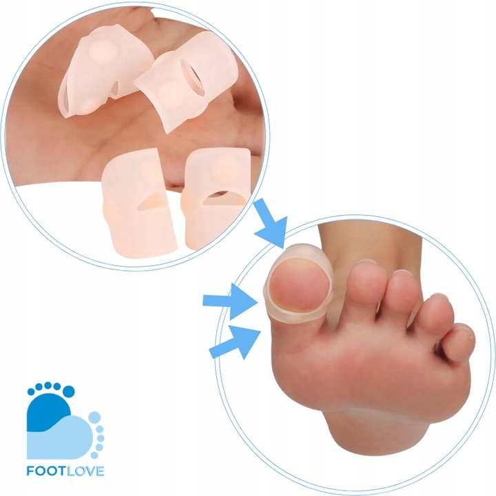 Nakładki silikonowe na wrastający paznokieć N75