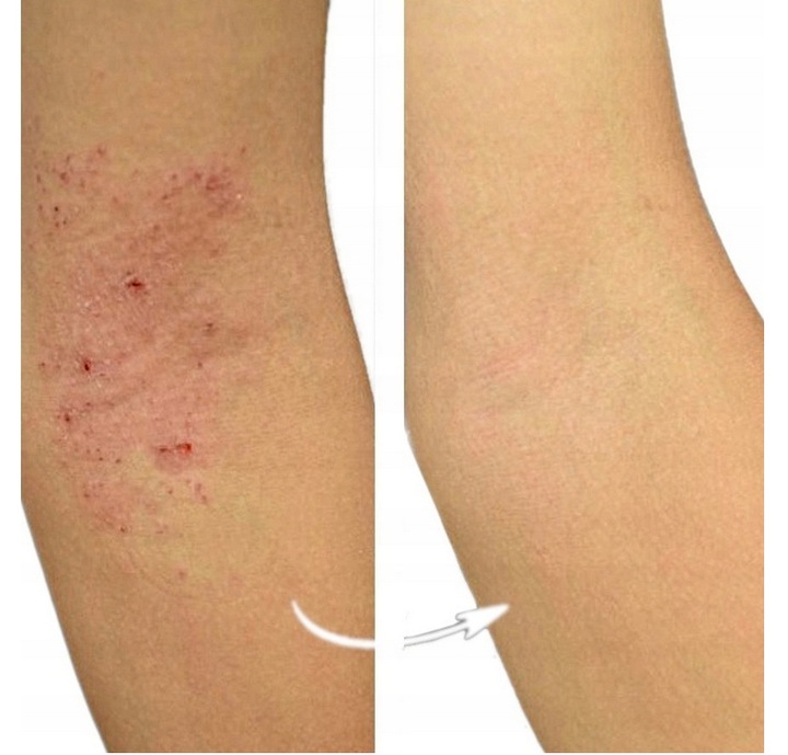 Blue CAP Krem Skóra Egzema Łuszczyca Łojotok Atopowe Zapalenie 50g