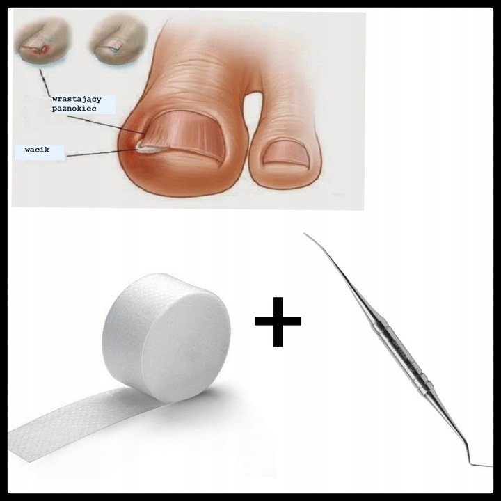 WRASTAJĄCE PAZNOKCIE Sonda Tamponada opatrunek
