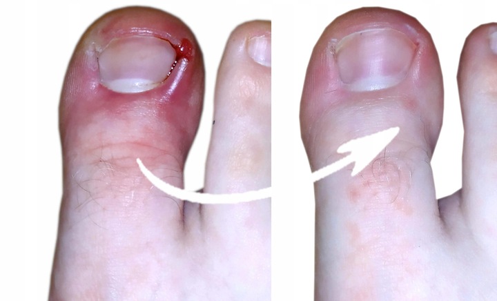 SPRAY NA GRZYBICĘ PAZNOKCI Z JONAMI SREBRA 100ml