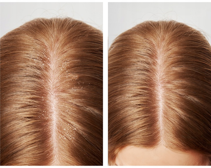 Szampon do włosów PRZECIWŁUPIEŻOWY Z PIROKTONEM OLAMINY cynk NUTRIDOME