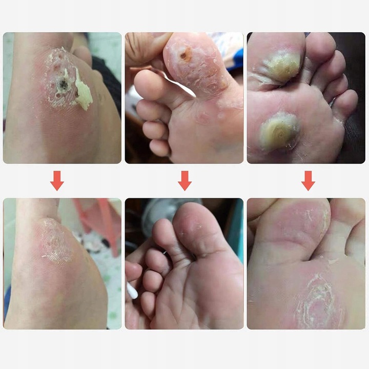 Plastry Usuwające Kurzajki na odciski Odcisków Stóp Plastry 42 Szt