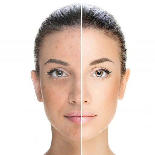 Derma wand DARSONVAL do zabiegów na TWARZY WŁOSY 4 elektrody NAJMOCNIEJSZY