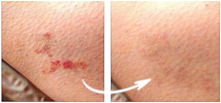 Blue CAP Krem Skóra Egzema Łuszczyca Łojotok Atopowe Zapalenie 50g