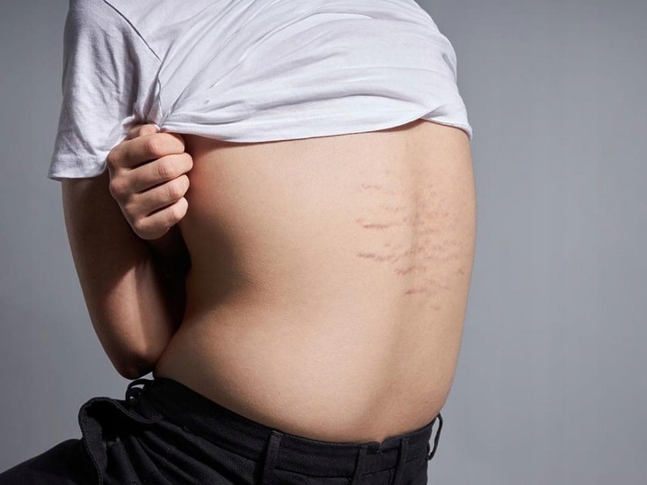 Dobry krem na rozstępy dla nastolatków na plecach brzuchu udach ramionach