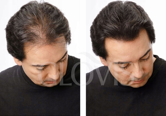 Włókna GLOVIS 50g Eko-Saszetka Mikrowłókna Zagęszczanie Rzadkich Włosów*