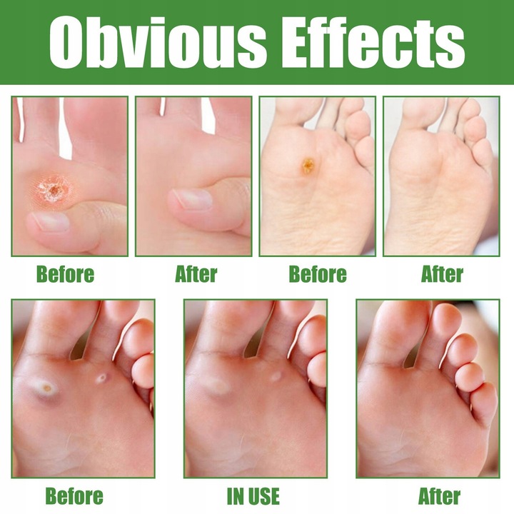 Plastry Usuwające Kurzajki na odciski 30szt