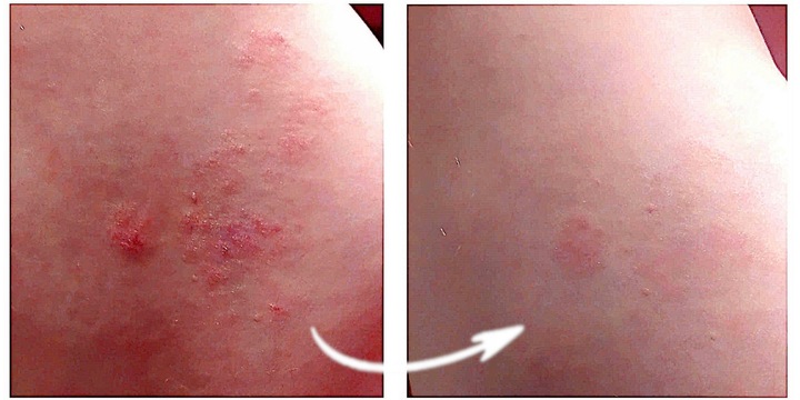 Blue CAP Krem Skóra Egzema Łuszczyca Łojotok Atopowe Zapalenie 50g