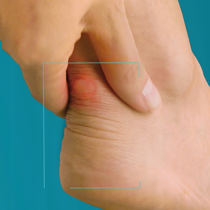 COMPEED plastry na pęcherze odciski mix 5 szt