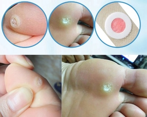 Plastry Usuwające Kurzajki na odciski 30szt