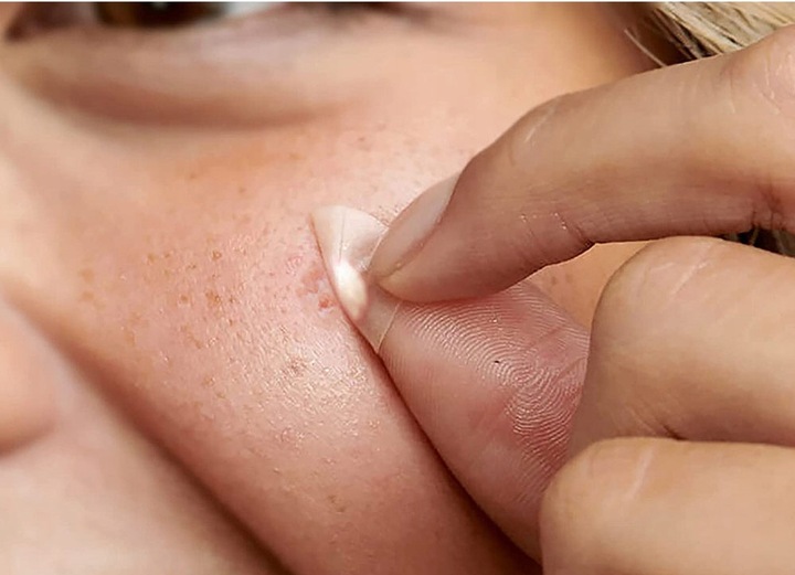 Plastry hydrokoloidowe na wypryski pryszcze 72 szt