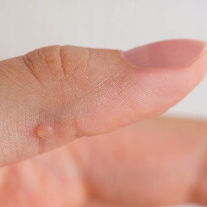 Glistnik Górski na Kurzajki Brodawki Modzele Jaskółcze Ziele Ekstrakt 20 ml