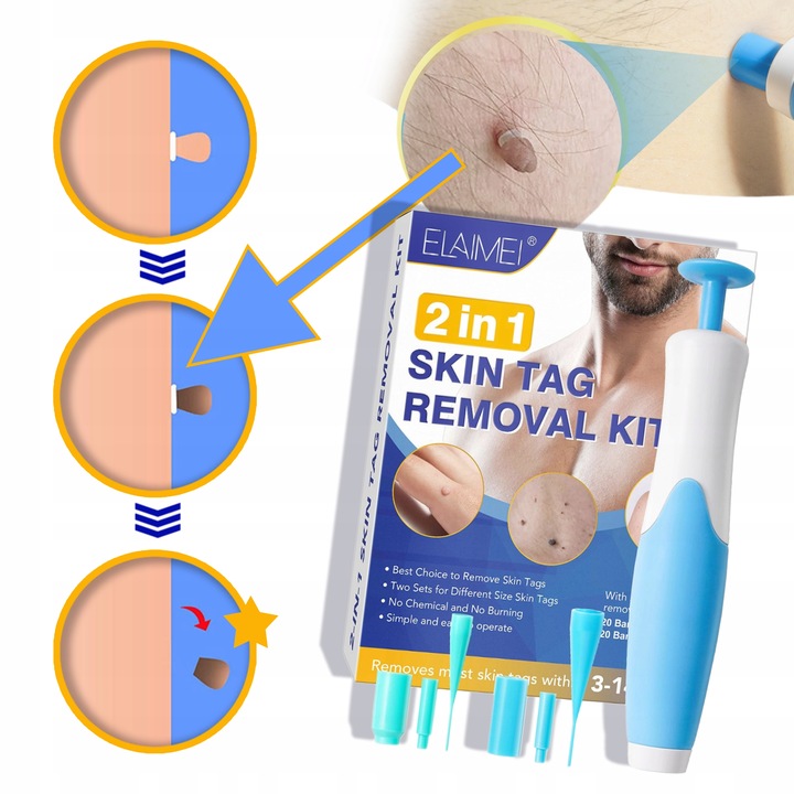 2 In1 Bezbolesne Auto Skóry Tag Mole Zestaw Do Usuwania Brodawek