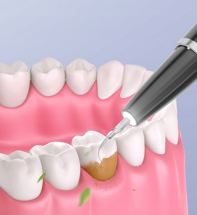 Skaler Ultradźwiękowy Do Zębów - 5 trybów do usuwania kamienia nazębnego