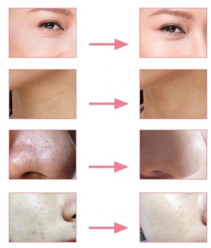 DIAMENTOWA MIKRODERMABRAZJA LIFTING Mocna 100W