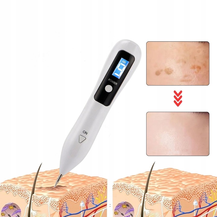 DŁUGOPIS PLAZMOWY PLAZMA PEN LASER IPL LIFTING TWARZY USUWANIE KURZAJEK