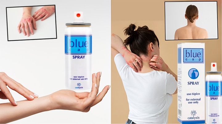 Blue Cap Spray 200 ml na łuszczycę AZS egzema - łagodzący świąd skóry