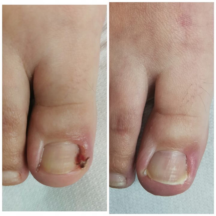 WRASTAJĄCE PAZNOKCIE Sonda Tamponada opatrunek