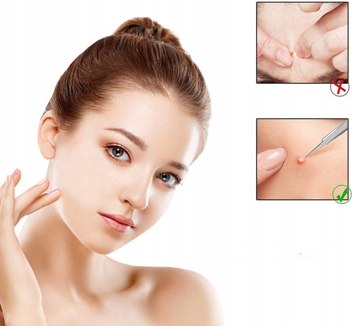 10× łyżeczki UNNY pęseta igła do usuwania zaskórników wągrów pryszczy